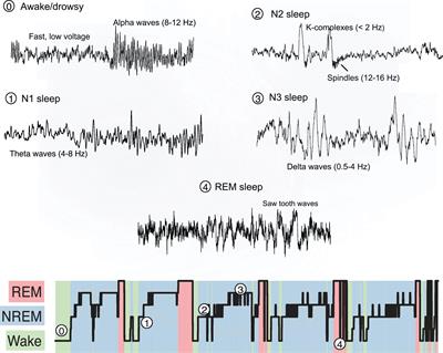 New and Emerging Approaches to Better Define Sleep Disruption and Its Consequences